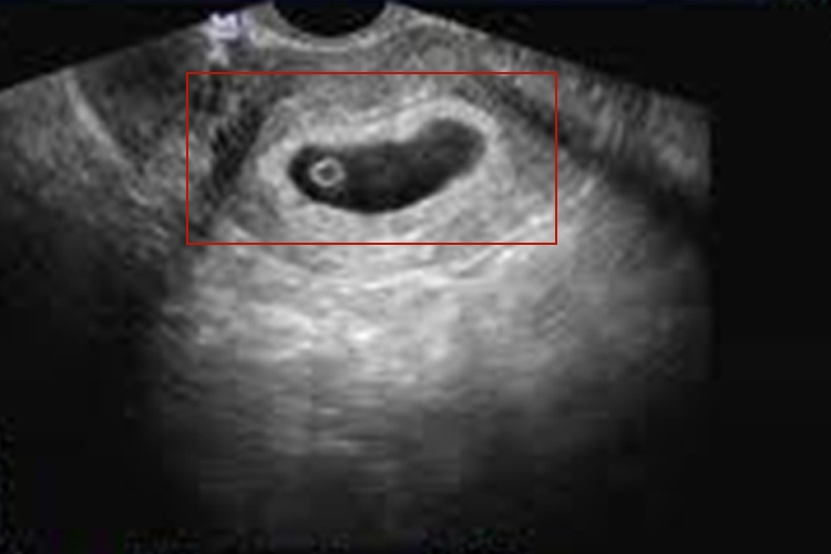 怀孕初期孕囊细长图