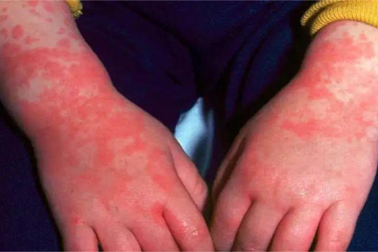 川崎病红疹图