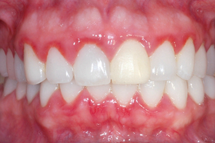 牙龈炎口腔牙龈红肿图