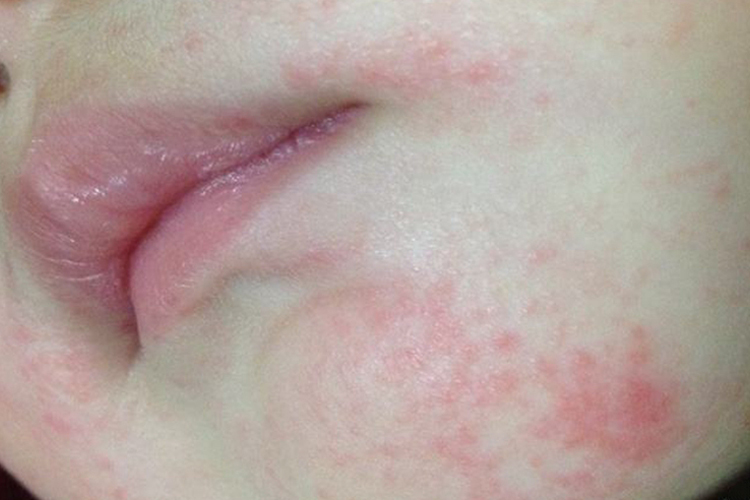 宝宝嘴边湿疹图 宝宝嘴边湿疹图