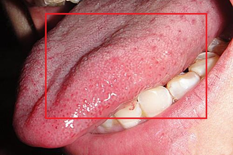 丝状乳头炎图 丝状乳头炎图