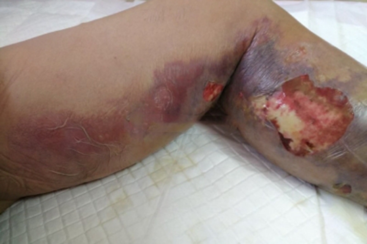 坏死性筋膜炎腿部糜烂图