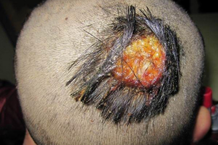 脓癣头皮上有黄色结痂图