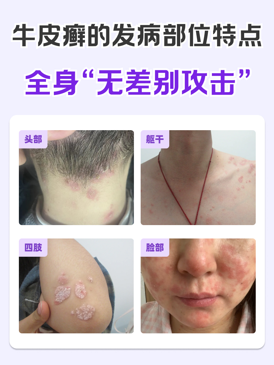 牛皮癣的特点？皮肤科医生带你全面了解！