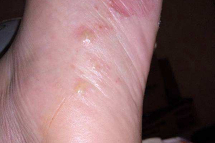 幼年型类天疱疮脚底症状图 幼年型类天疱疮脚底症状图