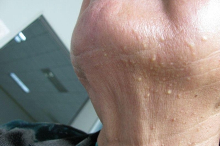 继发性粟丘疹颈部丘疹图