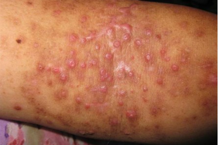 痘疮样型副银屑病胳膊脓包图