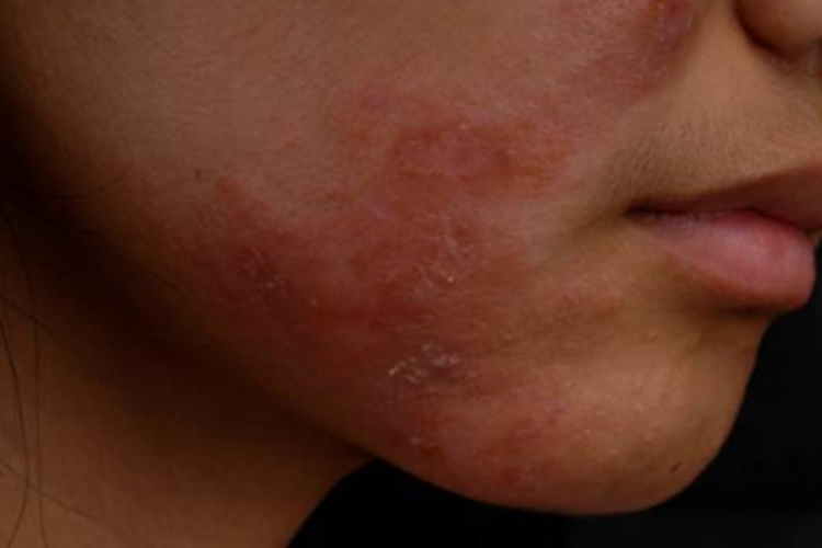 面部变应性接触性皮炎面部脱屑图