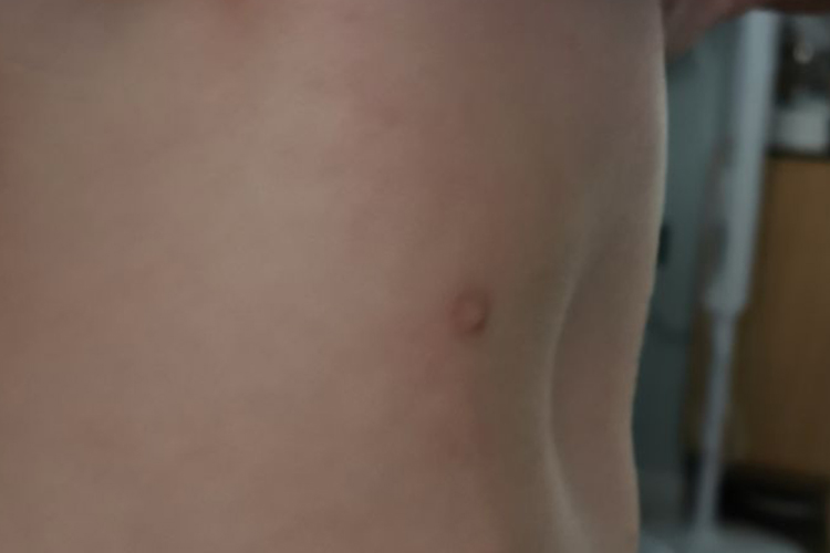 漏斗胸胸部凹陷图