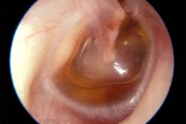 耳镜下积液图 耳镜下积液图