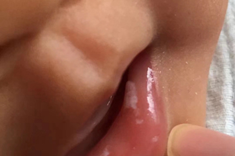 鹅口疮嘴唇内侧有白色斑点图 鹅口疮嘴唇内侧有白色斑点图