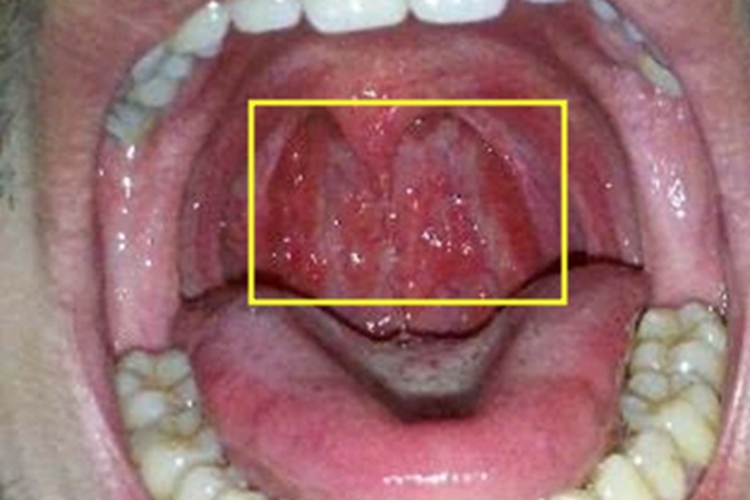 淋菌性咽炎疙瘩图