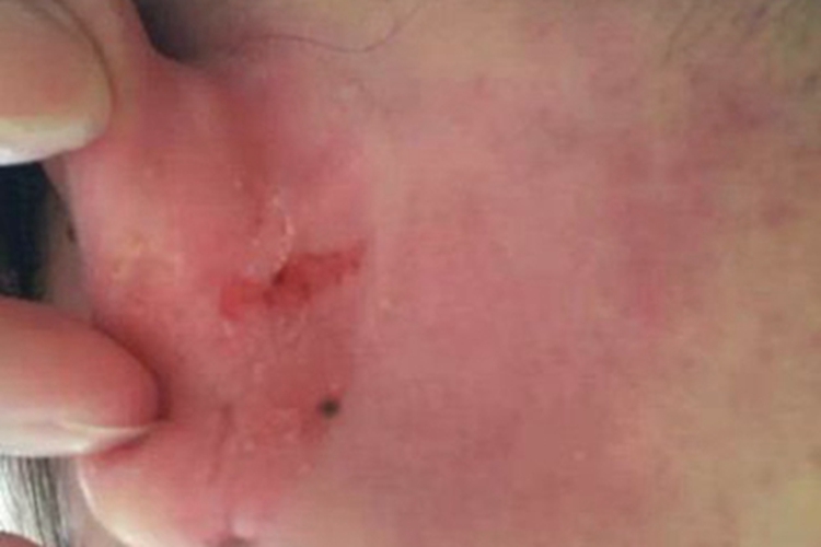 外耳湿疹耳后皮肤有裂口图