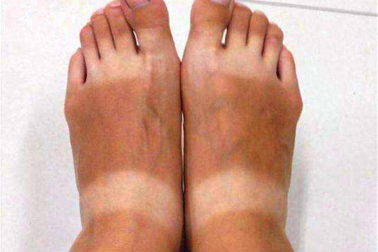 日晒皮炎脚部黑色素沉着图
