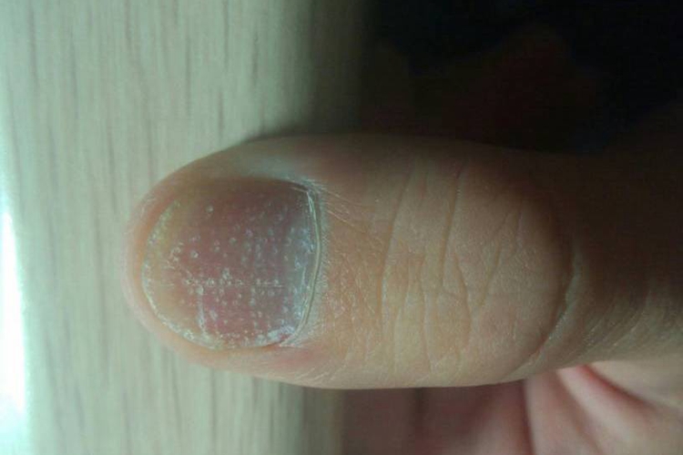 甲凹点图 甲凹点图