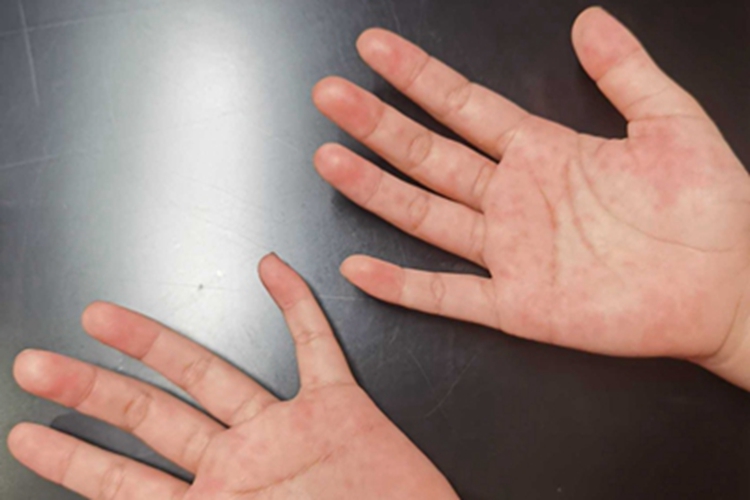 过敏性皮炎手掌出现红点点图