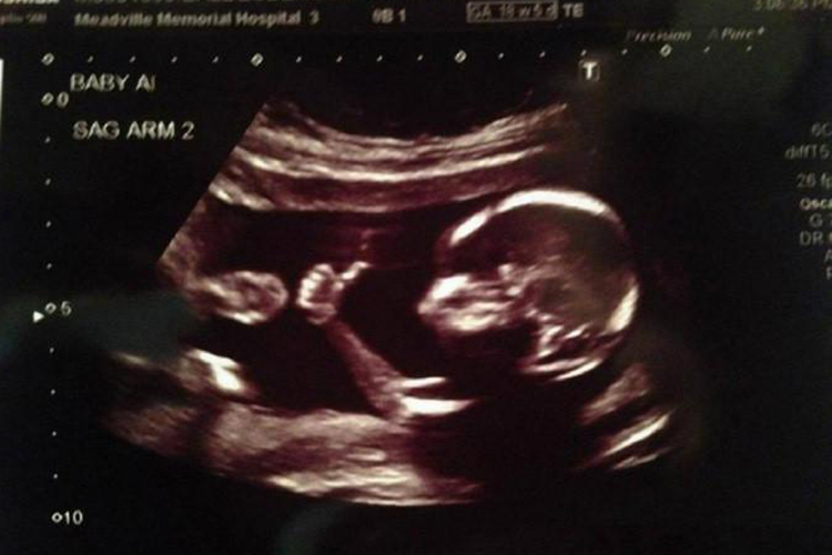 18周胎儿的B超图