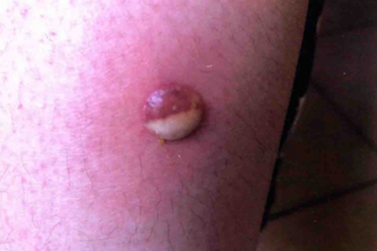 大疱性脓疱疮大腿脓包图