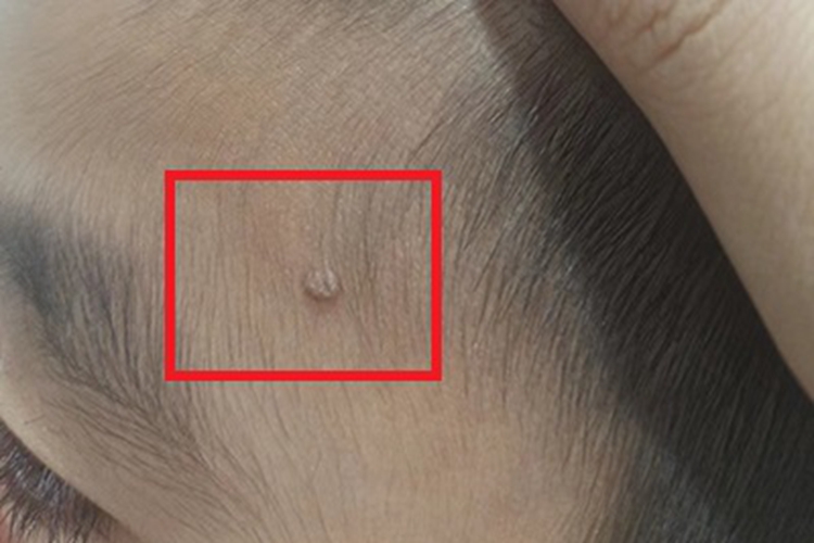 疣软疙瘩图 疣软疙瘩图