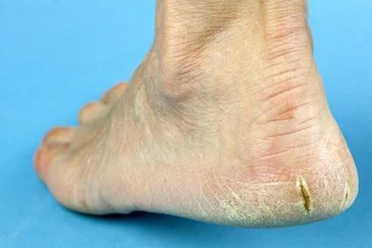 脚后跟皲裂图 脚后跟皲裂图