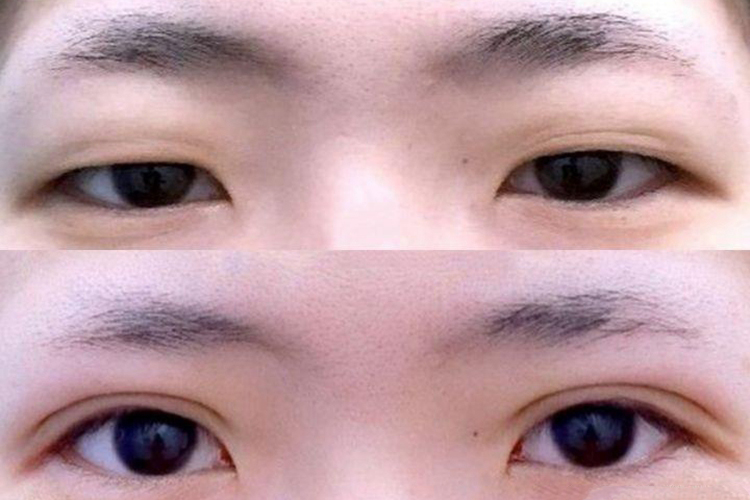 肿眼泡双眼皮对比图