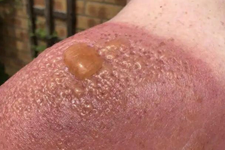 慢性光化性皮炎肩部症状图