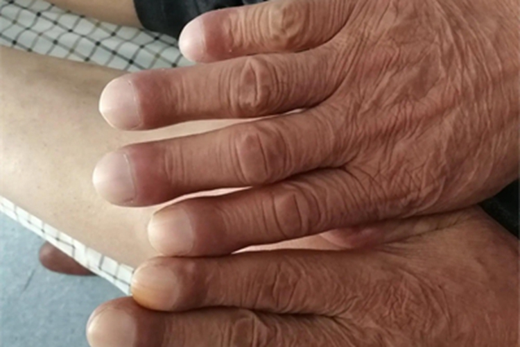 杵状指手指尖增厚图