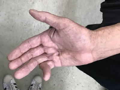 掌腱膜挛缩症小拇指挛缩畸形图.jpg
