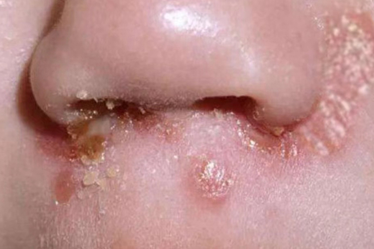 新生儿痤疮图 新生儿痤疮图