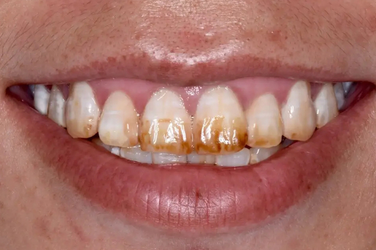 氟牙症图 氟牙症图