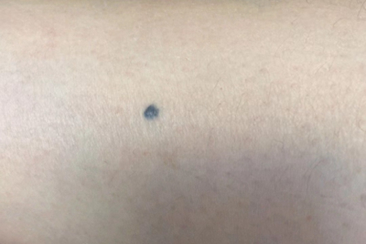 皮内痣黑色小结节图 皮内痣黑色小结节图