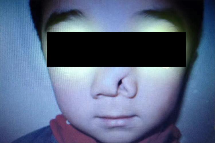先天性鼻侧裂图 先天性鼻侧裂图