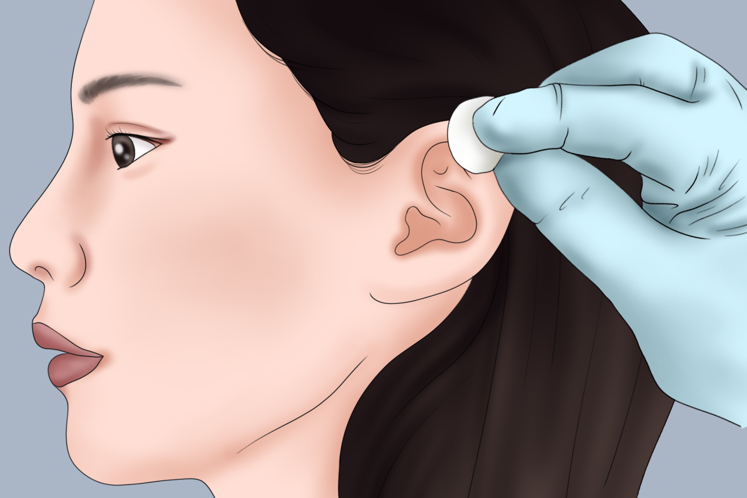 刺络放血针刺前消毒图