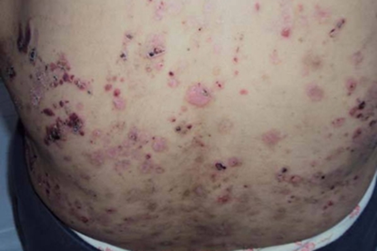 落叶型天疱疮血痂图 落叶型天疱疮血痂图