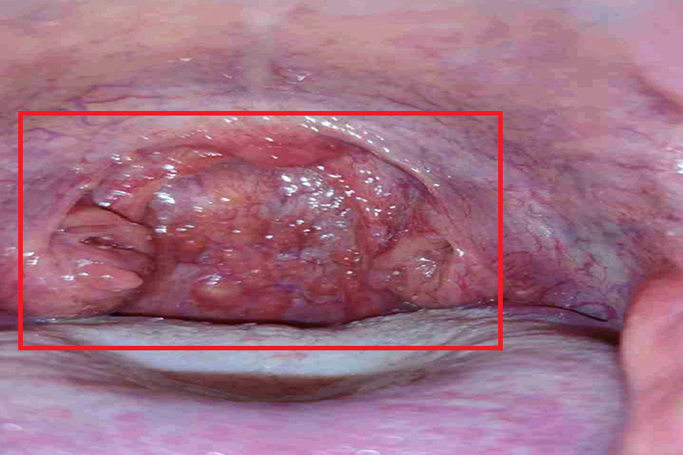 慢性咽炎图 慢性咽炎图