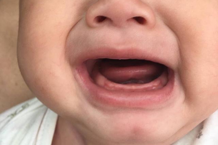 婴儿下牙床标准图