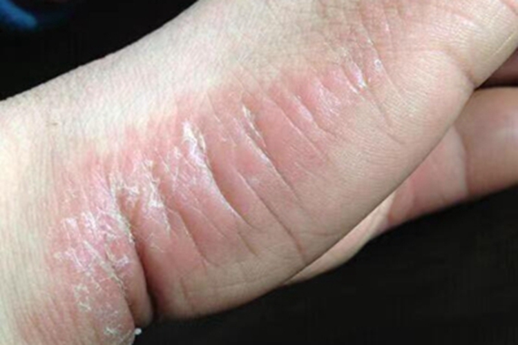 亚急性湿疹脱皮图 亚急性湿疹脱皮图