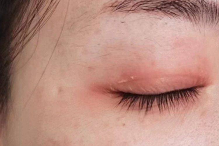 过敏性眼睑皮肤炎眼睑红肿脱屑图