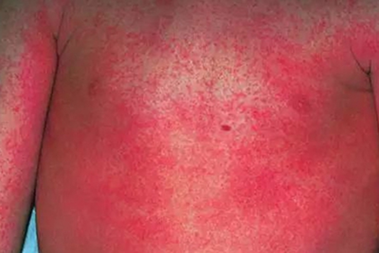 普通型猩红热胸部丘疹图