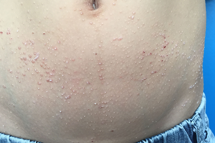 “鸡皮”样外观图