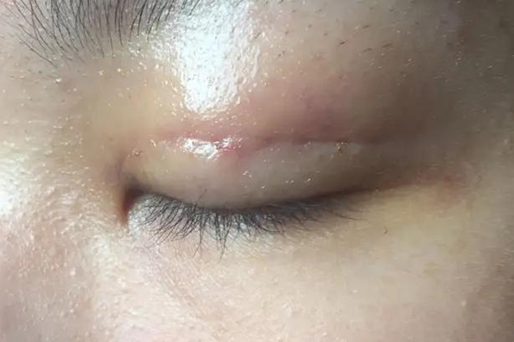 双眼皮埋线手术感染鼓个小包图片