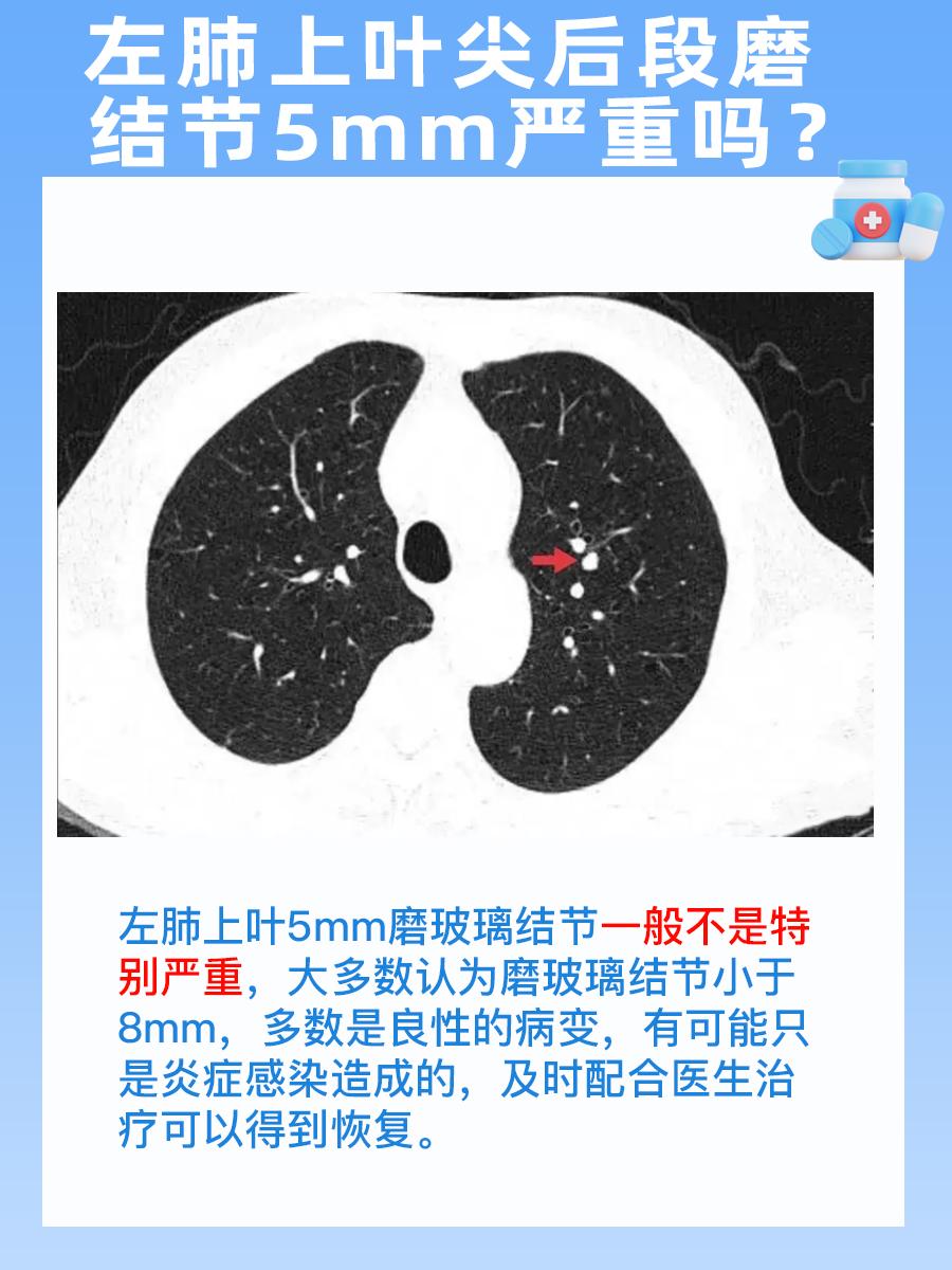 警惕！左肺上叶5mm磨玻璃结节是否严重？