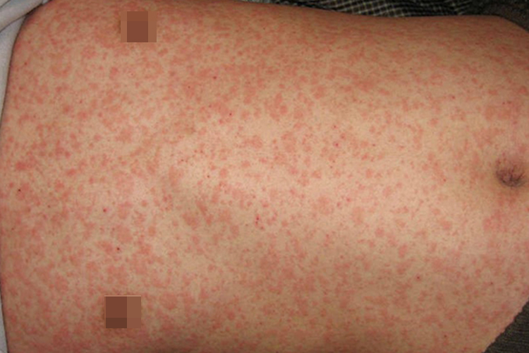 阿昔洛韦过敏麻疹型药疹图