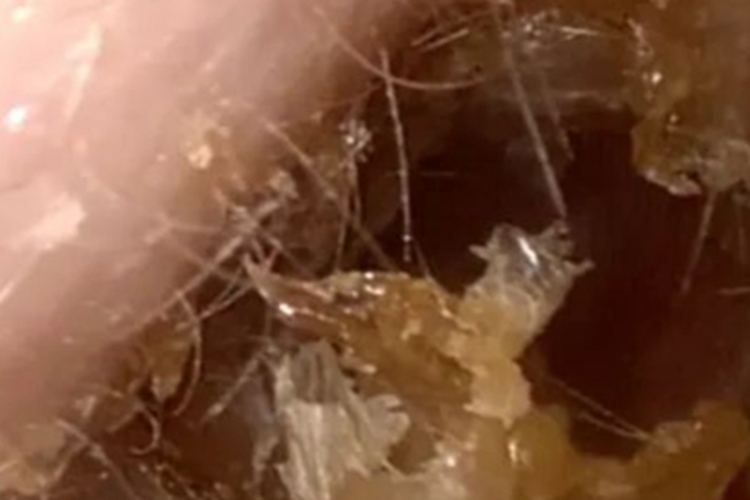 霉菌性外耳道炎结痂图