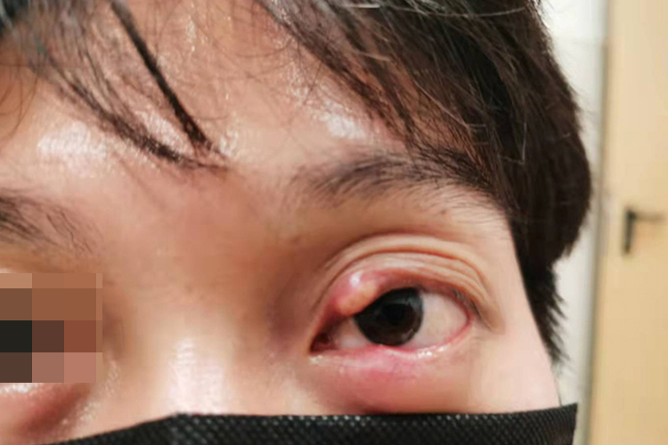 上眼皮外睑腺炎图 上眼皮外睑腺炎图