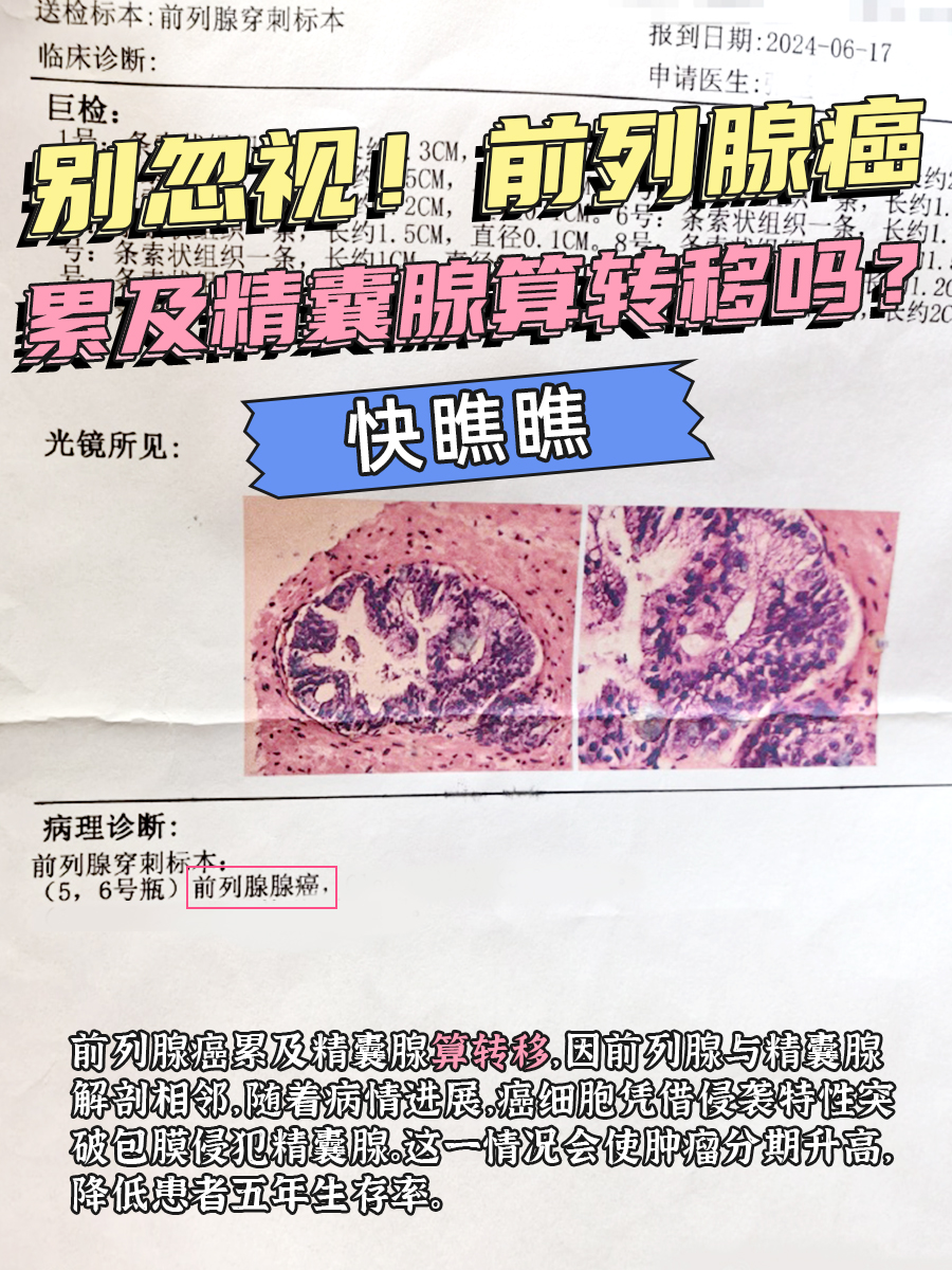 别忽视!前列腺癌累及精囊腺算转移吗?快瞧瞧