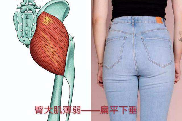 肌肉萎缩性疾病臀部扁凹图