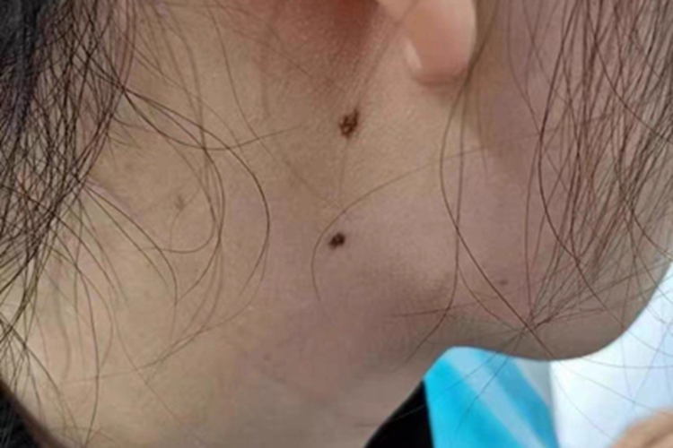 交界痣侧颈斑图