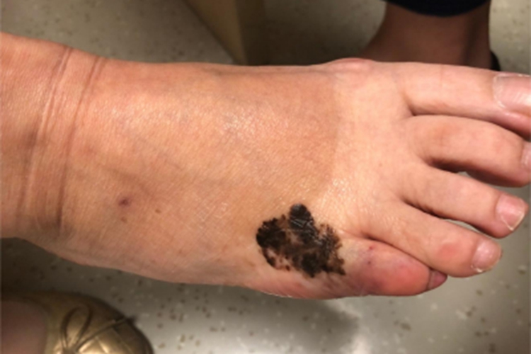恶性黑色素瘤脚背症状图