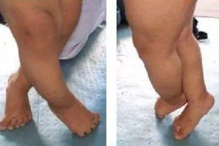 交叉剪刀步态图